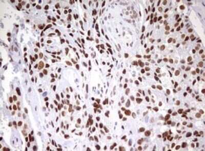 Immunohistochemistry: CDCA7L Antibody (OTI3B5) - Azide and BSA Free [NBP2-72009] - Analysis of Adenocarcinoma of Human breast tissue. (Heat-induced epitope retrieval by 10mM citric buffer, pH6.0, 120C for 3min)