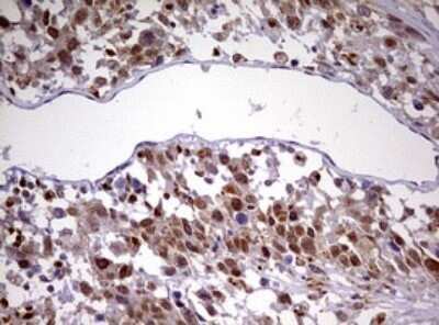 Immunohistochemistry: CDCA7L Antibody (OTI3B5) - Azide and BSA Free [NBP2-72009] - Analysis of Adenocarcinoma of Human ovary tissue. (Heat-induced epitope retrieval by 10mM citric buffer, pH6.0, 120C for 3min)