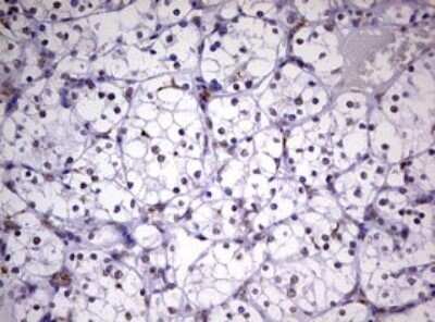 Immunohistochemistry: CDCA7L Antibody (OTI3B5) - Azide and BSA Free [NBP2-72009] - Analysis of Carcinoma of Human kidney tissue. (Heat-induced epitope retrieval by 10mM citric buffer, pH6.0, 120C for 3min)