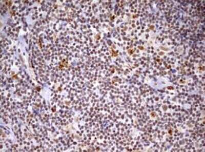 Immunohistochemistry: CDCA7L Antibody (OTI3B5) - Azide and BSA Free [NBP2-72009] - Analysis of Human lymphoma tissue. (Heat-induced epitope retrieval by 10mM citric buffer, pH6.0, 120C for 3min)