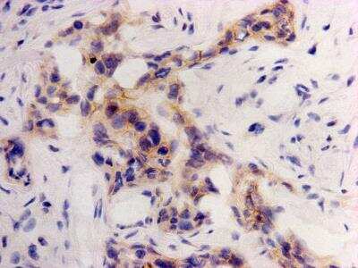 Immunohistochemistry-Paraffin: CDCP1 Antibody (B2-E6) [NBP2-75929] - Analysis of  human breast cancer tissue using anti-CDCP1 antibody. Counter stained with hematoxylin.
