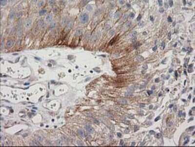 Immunohistochemistry: CDCP1 Antibody (OTI2C1) - Azide and BSA Free [NBP2-72156] - Staining of paraffin-embedded Carcinoma of Human bladder tissue using anti-CDCP1 mouse monoclonal antibody.