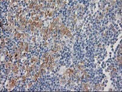Immunohistochemistry: CDCP1 Antibody (OTI2C1) - Azide and BSA Free [NBP2-72156] - Staining of paraffin-embedded Human lymphoma tissue using anti-CDCP1 mouse monoclonal antibody.
