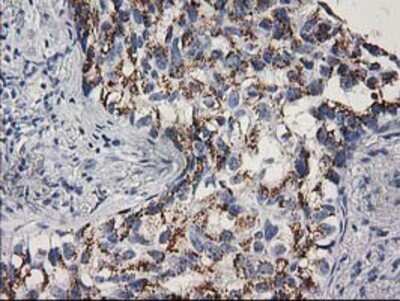 Immunohistochemistry: CDK2 Antibody (OTI2D9) - Azide and BSA Free [NBP2-70392] - Staining of paraffin-embedded Carcinoma of Human lung tissue using anti-Cdk2 mouse monoclonal antibody.