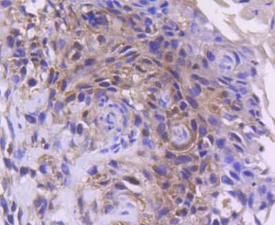 Immunohistochemistry-Paraffin: CDK4 Antibody (SD20-42) [NBP2-67736] - Analysis of paraffin-embedded human breast carcinoma tissue using anti-Cdk4 antibody. Counter stained with hematoxylin.