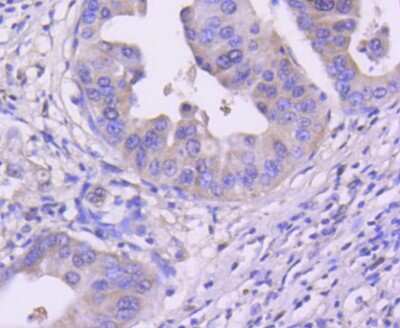 Immunohistochemistry-Paraffin: CDK4 Antibody (SD20-42) [NBP2-67736] - Analysis of paraffin-embedded human gastric carcinoma tissue using anti-Cdk4 antibody. Counter stained with hematoxylin.