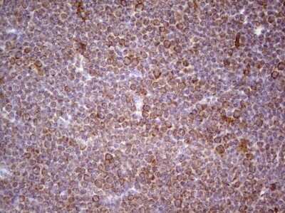 Immunohistochemistry: CDKL1 Antibody (1D9) [NBP2-46217] - Analysis of Human lymphoma tissue.