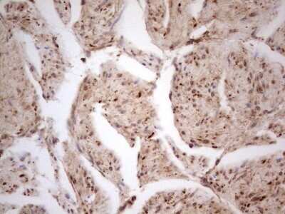 Immunohistochemistry: CDKL1 Antibody (OTI1D9) - Azide and BSA Free [NBP2-71389] - Analysis of Human prostate Carcinoma tissue.