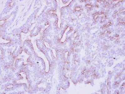 Immunohistochemistry-Paraffin: CDO Antibody [NBP2-15849] -  Human breast cancer, using CDO antibody at 1:250 dilution. Antigen Retrieval: Trilogy™ (EDTA based, pH 8.0) buffer, 15min.