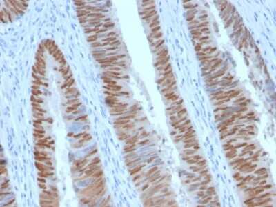 Immunohistochemistry-Paraffin: CDX2 Antibody (CDX2/2951R) - Azide and BSA Free [NBP3-08738] - Formalin-fixed, paraffin-embedded human Colon Carcinoma stained with CDX2 Rabbit Recombinant Monoclonal Antibody (CDX2/2951R).
