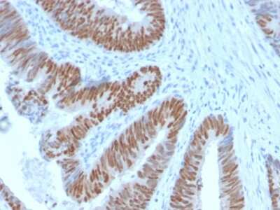 Immunohistochemistry-Paraffin: CDX2 Antibody (CDX2/2951R) - Azide and BSA Free [NBP3-08738] - Formalin-fixed, paraffin-embedded human Colon Carcinoma stained with CDX2 Rabbit Recombinant Monoclonal Antibody (CDX2/2951R).