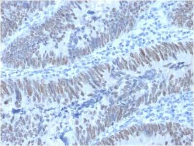 Immunohistochemistry-Paraffin: CDX2 Antibody (PCRP-CDX2-1A3) - Azide and BSA Free [NBP2-75759] - Formalin-fixed, paraffin-embedded human Colon Carcinomastained with CDX2 Mouse Monoclonal Antibody (PCRP-CDX2-1A3).