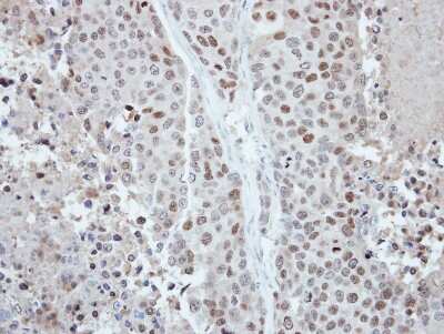 Immunohistochemistry-Paraffin: CDYL Antibody [NBP2-15851] -  BT474 xenograft, using CDYL antibody at 1:250 dilution.  Antigen Retrieval: Trilogy™ (EDTA based, pH 8.0) buffer, 15min.