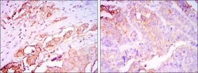 Immunohistochemistry-Paraffin: CEACAM-5/CD66e Antibody (1C7) [NBP2-22173] - CEACAM5 Antibody (1C7) Immunohistochemical analysis of paraffin-embedded rectum cancer tissues (left) and stomach cancer tissues (right) using Carcino Embryonic Antigen CEA mouse mAb with DAB staining.