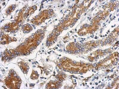 Immunohistochemistry-Paraffin: CEACAM21 Antibody [NBP2-15853] - Immunohistochemical analysis of paraffin-embedded Colon ca, using antibody at 1:500 dilution.