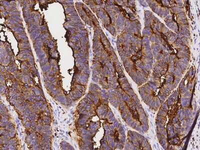 Immunohistochemistry-Paraffin: CEACAM3/CD66d Antibody [NBP2-99909] - Immunochemical staining of human CEACAM3/CD66d in human colon carcinoma with rabbit polyclonal antibody at 1:1000 dilution, formalin-fixed paraffin embedded sections.