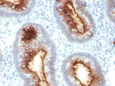 Immunohistochemistry-Paraffin: CEACAM5/CD66e Antibody (C66/1030) - Azide and BSA Free [NBP2-47977] - Human Colon Carcinoma stained with CEA Mouse Monoclonal Antibody (C66/1030).