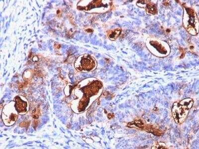 Immunohistochemistry-Paraffin: CEACAM5/CD66e Antibody (C66/1260) - IHC-Prediluted [NBP2-48043] - Formalin-fixed, paraffin-embedded human Colon Carcinoma stained with CEA Mouse Monoclonal Antibody (C66/1260).