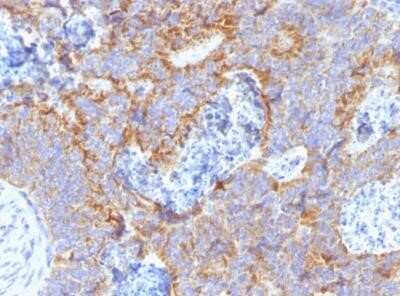 Immunohistochemistry-Paraffin: CEACAM5/CD66e Antibody (C66/1291) - Azide and BSA Free [NBP2-54429] - Human Colon stained with CEACAM5/CD66e Antibody (C66/1291).