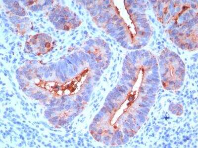 Immunohistochemistry-Paraffin: CEACAM5/CD66e Antibody (C66/195) - Azide and BSA Free [NBP2-47973] - Human Colon Carcinoma stained with CEA Monoclonal Antibody (C66/195)