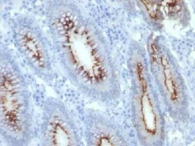 Immunohistochemistry-Paraffin: CEACAM5/CD66e Antibody (C66/261) - Azide and BSA Free [NBP2-34586] - Formalin-fixed, paraffin-embedded human colon Carcinoma stained with CEA Monoclonal Antibody (C66/261)