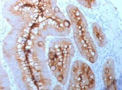 Immunohistochemistry-Paraffin: CEACAM5/CD66e Antibody (C66/261) - Azide and BSA Free [NBP2-34586] - Human Colon Carcinoma stained with CEACAM5/CD66e Antibody (C66/261).