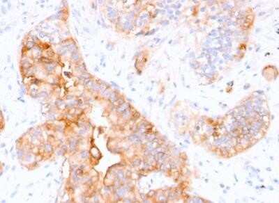 Immunohistochemistry-Paraffin: CEACAM5/CD66e Antibody (CEA31) - IHC-Prediluted [NBP2-44901] - Human Colon Carcinoma stained with CEACAM5/CD66e Antibody (CEA31).