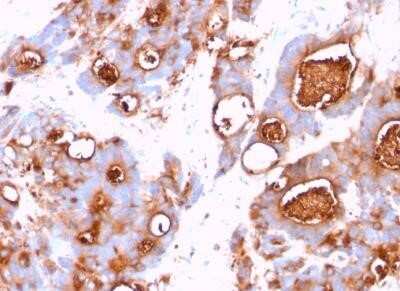 Immunohistochemistry-Paraffin: CEACAM5/CD66e Antibody (CEA31) - IHC-Prediluted [NBP2-44901] - Human Colon Carcinoma stained with CEACAM5/CD66e Antibody (CEA31).
