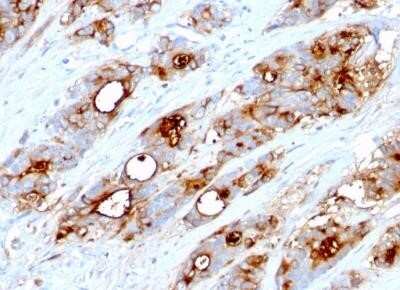 Immunohistochemistry-Paraffin: CEACAM5/CD66e Antibody (CEA31) - IHC-Prediluted [NBP2-44901] - Human Colon Carcinoma stained with CEACAM5/CD66e Antibody (CEA31).