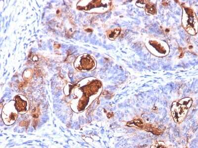 Immunohistochemistry-Paraffin: CEACAM5/CD66e Antibody (COL-1 + CEA31 + C66/261) - Azide and BSA Free [NBP2-34597] - Formalin-fixed, paraffin-embedded human colon carcinoma stained with CEA MAb (COL-1+CEA31+C66/261)