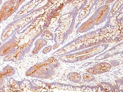 Immunohistochemistry-Paraffin: CEACAM5/CD66e Antibody (COL-1) - Azide and BSA Free [NBP3-05767] - Immunohistochemistry-Paraffin: CEACAM5/CD66e Antibody (COL-1) - Azide and BSA Free - Formalin-fixed, paraffin-embedded human colon carcinoma.