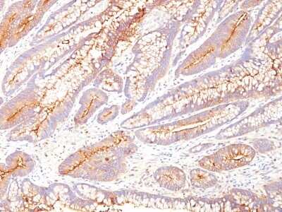 Immunohistochemistry-Paraffin: CEACAM5/CD66e Antibody (COL-1) - IHC-Prediluted [NBP3-05768] - Formalin-fixed, paraffin-embedded human colon carcinoma stained with CEACAM5/CD66e Antibody (COL-1).