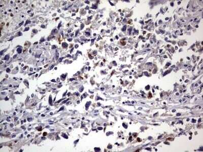 Immunohistochemistry: CEACAM5/CD66e Antibody (OTI3D8) - Azide and BSA Free [NBP2-70407] - Analysis of Adenocarcinoma of Human ovary tissue.