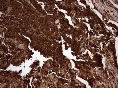 Immunohistochemistry: CEACAM5/CD66e Antibody (OTI3D8) - Azide and BSA Free [NBP2-70407] - Analysis of Carcinoma of Human bladder tissue.