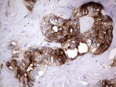 Immunohistochemistry: CEACAM5/CD66e Antibody (OTI3D8) - Azide and BSA Free [NBP2-70407] - Analysis of Carcinoma of Human liver tissue.