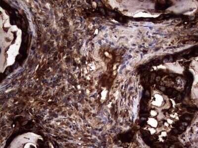 Immunohistochemistry: CEACAM5/CD66e Antibody (OTI3D8) - Azide and BSA Free [NBP2-70407] - Analysis of Carcinoma of Human lung tissue.