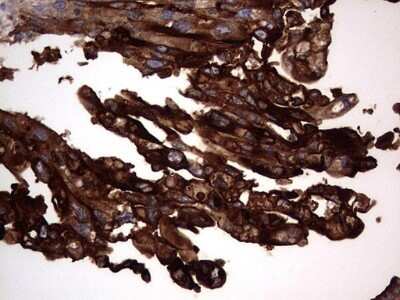 Immunohistochemistry: CEACAM5/CD66e Antibody (OTI3D8) - Azide and BSA Free [NBP2-70407] - Analysis of Carcinoma of Human pancreas tissue.