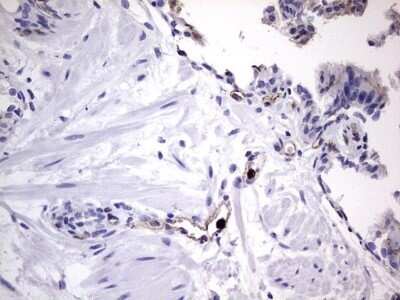 Immunohistochemistry: CEACAM5/CD66e Antibody (OTI3D8) - Azide and BSA Free [NBP2-70407] - Analysis of Carcinoma of Human prostate tissue.