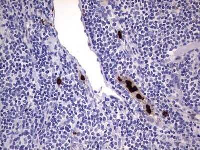 Immunohistochemistry: CEACAM5/CD66e Antibody (OTI3D8) - Azide and BSA Free [NBP2-70407] - Analysis of Human lymphoma tissue.
