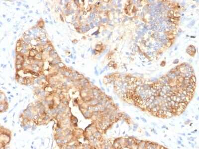 Immunohistochemistry-Paraffin: CEACAM5/CD66e Antibody (SPM330) - Azide and BSA Free [NBP2-47974] - Formalin-fixed, paraffin-embedded human colon carcinoma stained with CEACAM5/CD66e Mouse Monoclonal Antibody (C66/1009).