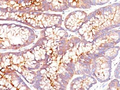 Immunohistochemistry-Paraffin: CEACAM5/CD66e Antibody (SPM541) - Azide and BSA Free [NBP2-34787] - Formalin-paraffin colon stained with CEA MAb (SPM541)