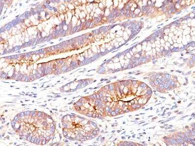 Immunohistochemistry-Paraffin: CEACAM5/CD66e Antibody (SPM551) - Azide and BSA Free [NBP2-34793] - Formalin-paraffin colon stained with CEA MAb (SPM551)