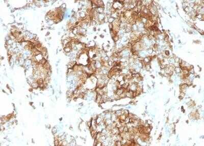 Immunohistochemistry-Paraffin: CEACAM5/CD66e Antibody (SPM584) - Azide and BSA Free [NBP2-34851] - Human Colon Carcinoma stained with CEACAM5/CD66e Antibody (SPM584).