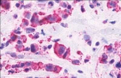 Immunohistochemistry-Paraffin: CELSR2 Antibody [NLS1942] - Anti-CELSR2 antibody IHC of human Breast, Carcinoma. Immunohistochemistry of formalin-fixed, paraffin-embedded tissue after heat-induced antigen retrieval.