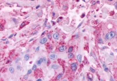 Immunohistochemistry-Paraffin: CELSR2 Antibody [NLS1942] - Anti-CELSR2 antibody IHC of human Colon, Carcinoma. Immunohistochemistry of formalin-fixed, paraffin-embedded tissue after heat-induced antigen retrieval.