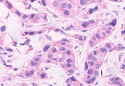 Immunohistochemistry-Paraffin: CELSR2 Antibody [NLS1943] - Anti-CELSR2 antibody IHC of human Breast, Carcinoma. Immunohistochemistry of formalin-fixed, paraffin-embedded tissue after heat-induced antigen retrieval.