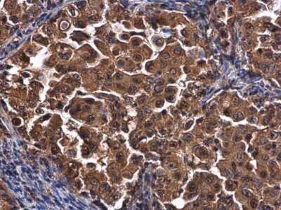 Immunohistochemistry-Paraffin: CEP192 Antibody [NBP3-13048] - CEP192 antibody detects CEP192 protein at cytoplasm in human lung cancer by immunohistochemical analysis. Sample: Paraffin-embedded human lung cancer. CEP192 antibody (NBP3-13048) diluted at 1:500. Antigen Retrieval: Citrate buffer, pH 6.0, 15 min