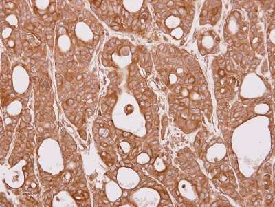 Immunohistochemistry-Paraffin: CEP57 Antibody [NBP2-15863] - Immunohistochemical analysis of paraffin-embedded NCI-N87 xenograft, using antibody at 1:100 dilution.