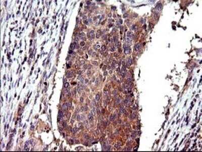 Immunohistochemistry: CEP68 Antibody (OTI5B4) - Azide and BSA Free [NBP2-71728] - Analysis of Carcinoma of Human lung tissue.