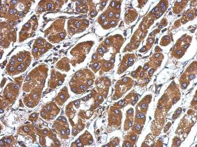 Immunohistochemistry-Paraffin: CFHR5 Antibody [NBP2-14912] - Paraffin-embedded Hepatoma, using antibody at 1:500 dilution.